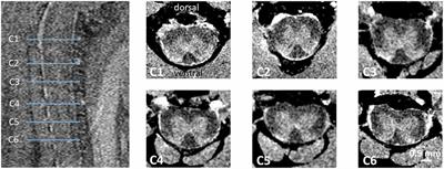 Structural MRI Reveals Cervical Spinal Cord Atrophy in the P301L Mouse Model of Tauopathy: Gender and Transgene-Dosing Effects
